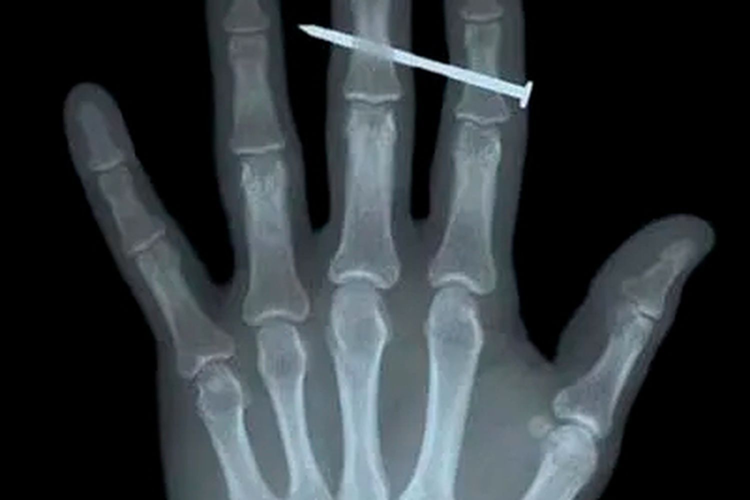 X-ray image of a left hand with a construction nail skewering the middle phalanx of the middle finger.