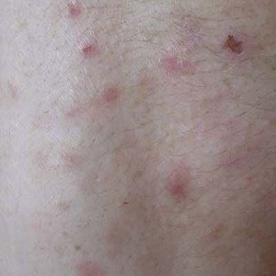 An allergic reaction rash caused by bedbug bites