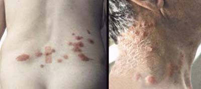 Two images of rashes caused by bedbug bites.