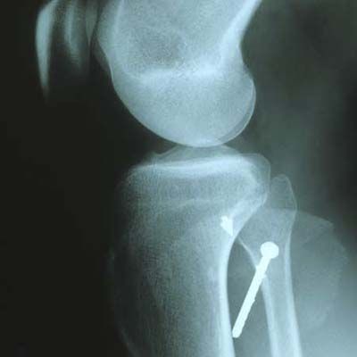 an x-ray showing a nail through a leg