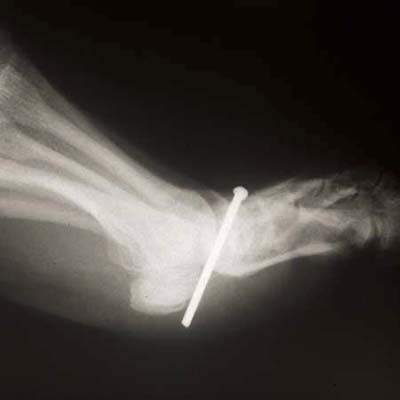 an x-ray showing a nail through a foot