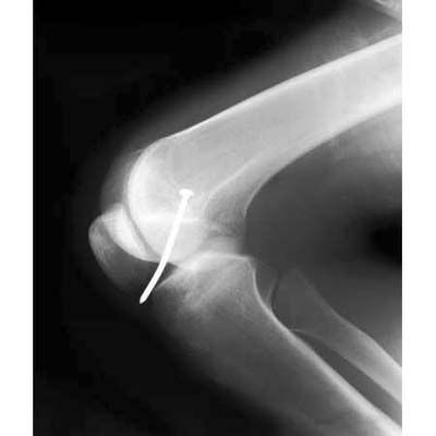 an x-ray showing a nail through a knee