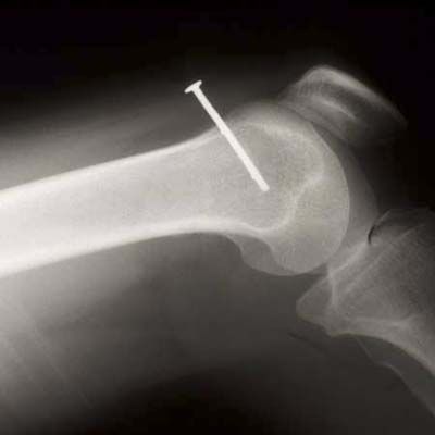 an x-ray showing a nail through an elbow