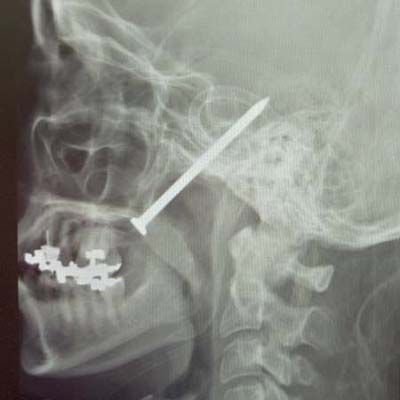 an x-ray showing a nail through a head