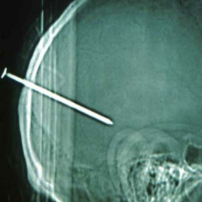 an x-ray showing a nail through the back of a head